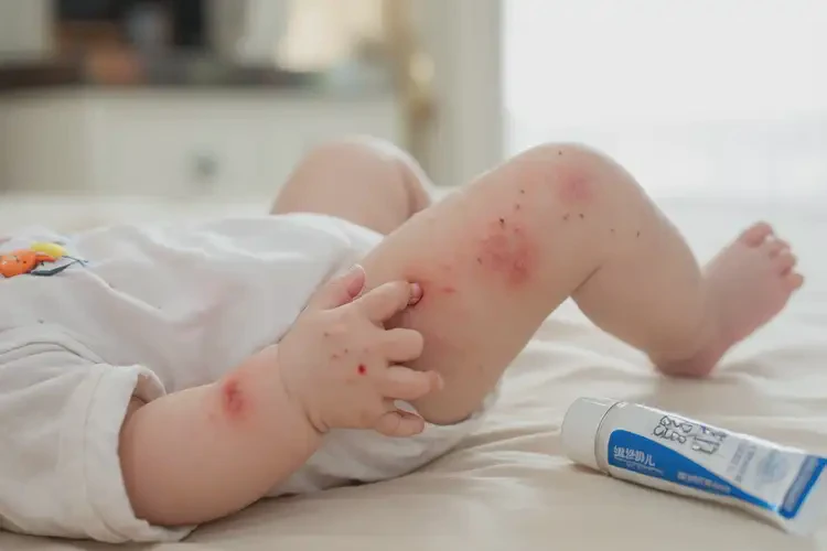 嬰兒四肢經(jīng)常起濕疹能治好嗎(圖4)