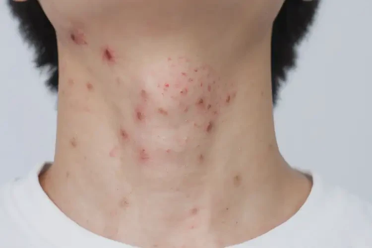 大學(xué)生脖子經(jīng)常起濕疹可以治好嗎(圖4)