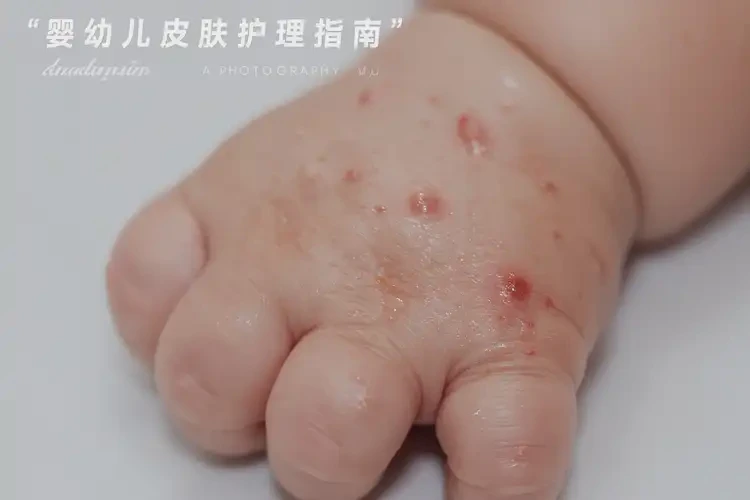 寶寶手上有濕疹可以治好嗎(圖2)