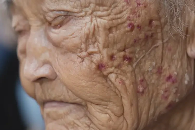 高龄老人屁股上经常长湿疹能不能彻底自愈(图4)