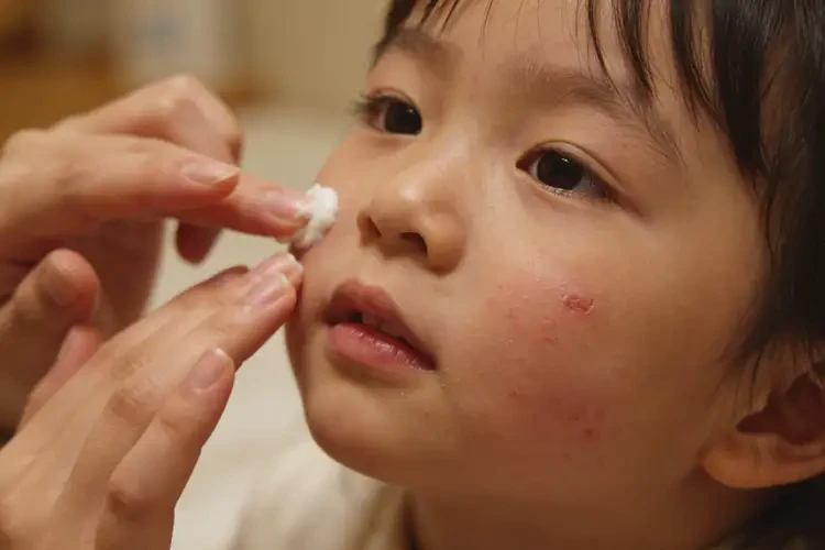 幼儿面部经常起湿疹可以治好吗(图3)