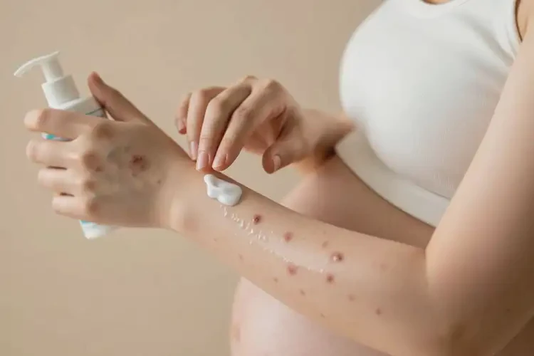 產(chǎn)婦手臂起濕疹可以治好嗎(圖4)