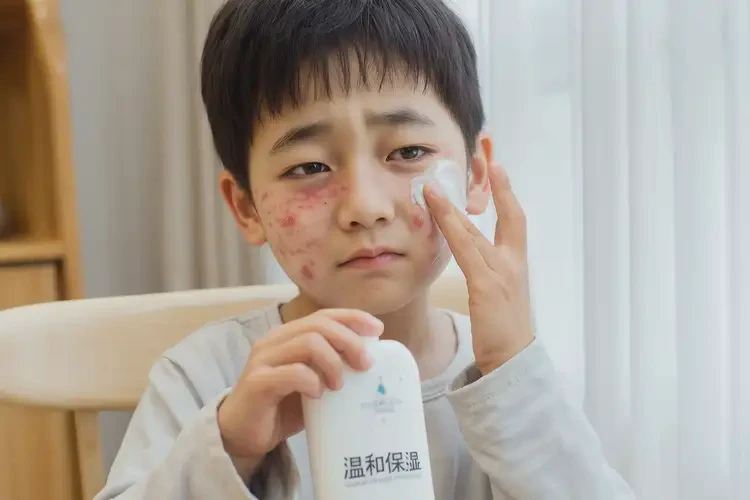 少兒臉上出濕疹能徹底自愈嗎(圖2)