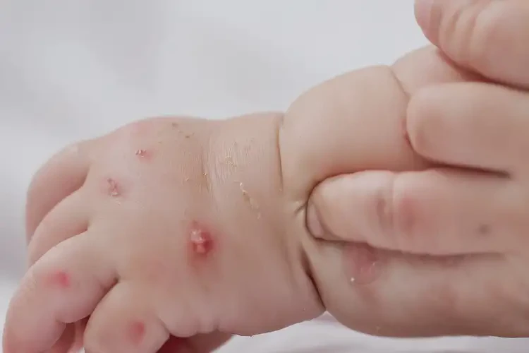 嬰兒手上出濕疹可以治好嗎(圖4)