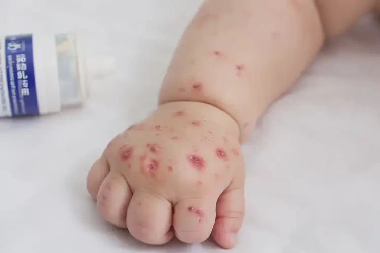 嬰幼兒手上經(jīng)常起濕疹能治好嗎(圖4)