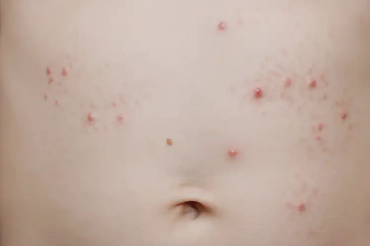 幼兒肚子上經(jīng)常長濕疹可以治好嗎(圖4)