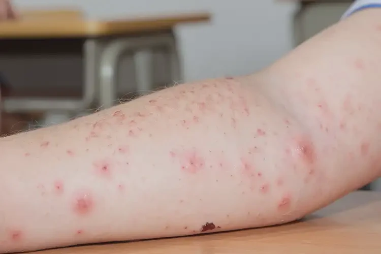 小学生四肢偶尔长湿疹可以治好吗(图4)