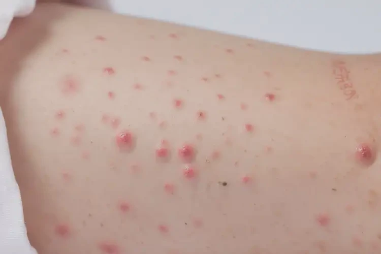 小兒大腿容易長濕疹可以治好嗎(圖4)