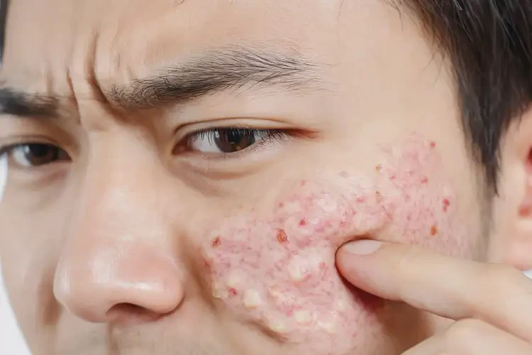 青年人臉上出現(xiàn)濕疹可以治好嗎(圖3)