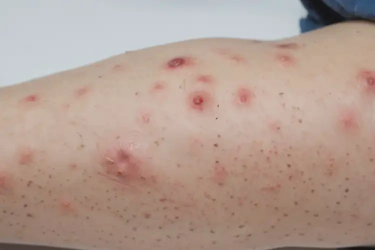 青少年小腿上經(jīng)常起濕疹可以治好嗎(圖4)