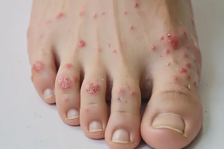 中學(xué)生腳上容易長(zhǎng)濕疹可以治好嗎(圖4)