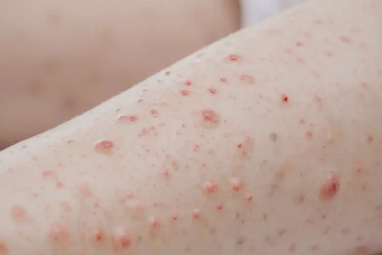 產(chǎn)婦手臂上長濕疹可以治好嗎(圖4)