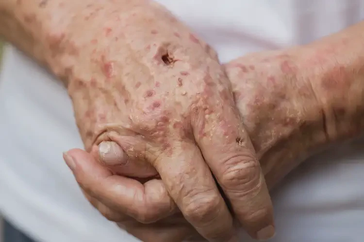 女性手上經(jīng)常長(zhǎng)濕疹能靠自己自愈嗎(圖4)
