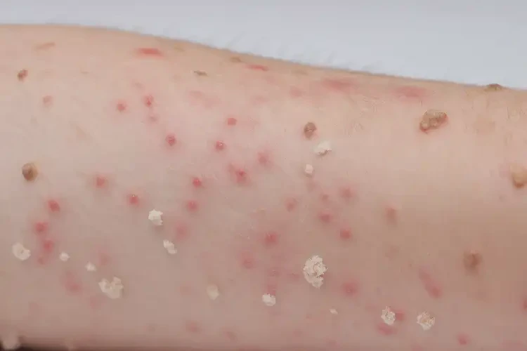 小孩身上長(zhǎng)濕疹不管它會(huì)自己痊愈嗎(圖4)