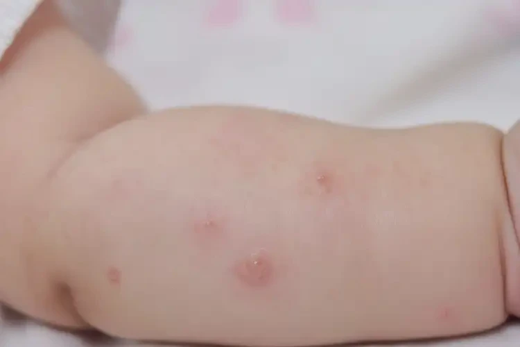 嬰幼兒手臂長濕疹可以治好嗎(圖4)