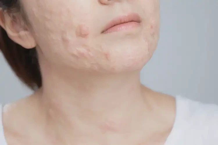 女人脖子出濕疹可以治好嗎(圖4)