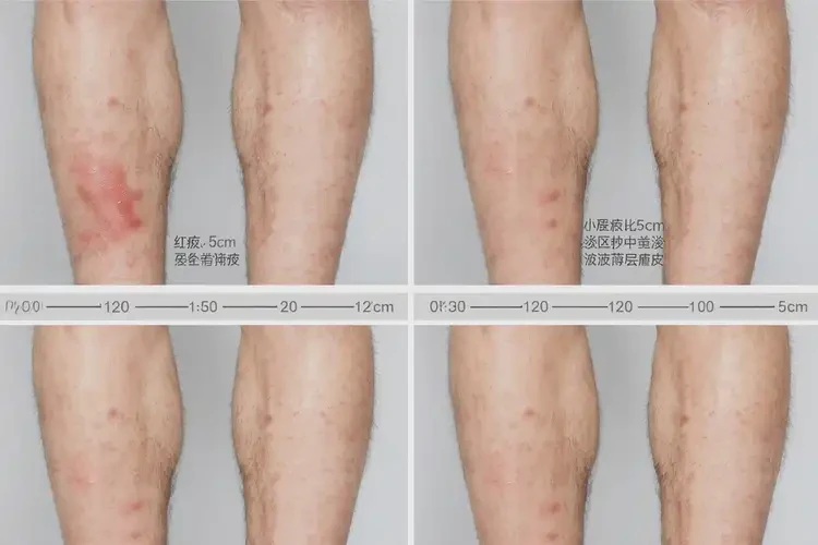 男生小腿上偶爾起濕疹可不可以徹底自愈(圖3)