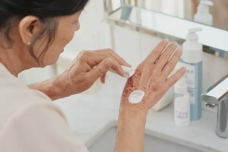 女性手上起濕疹可以治好嗎(圖3)