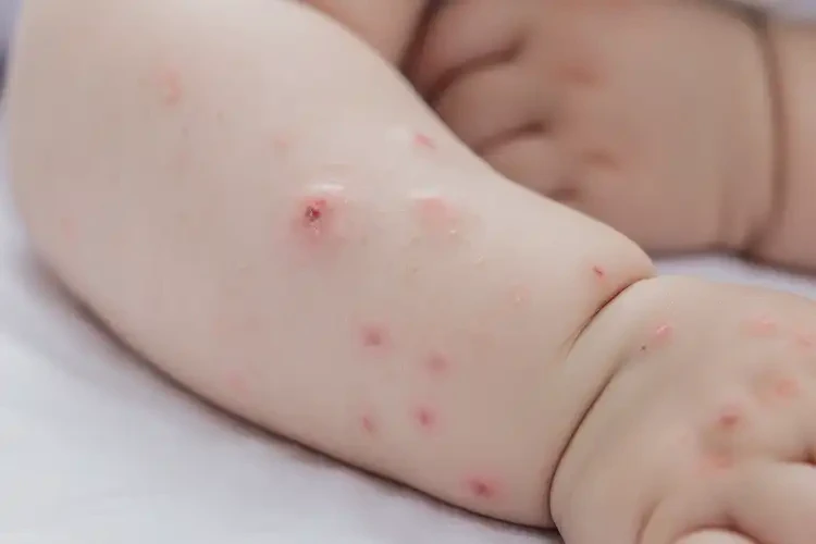 寶寶手臂上出現(xiàn)濕疹能治好嗎(圖4)