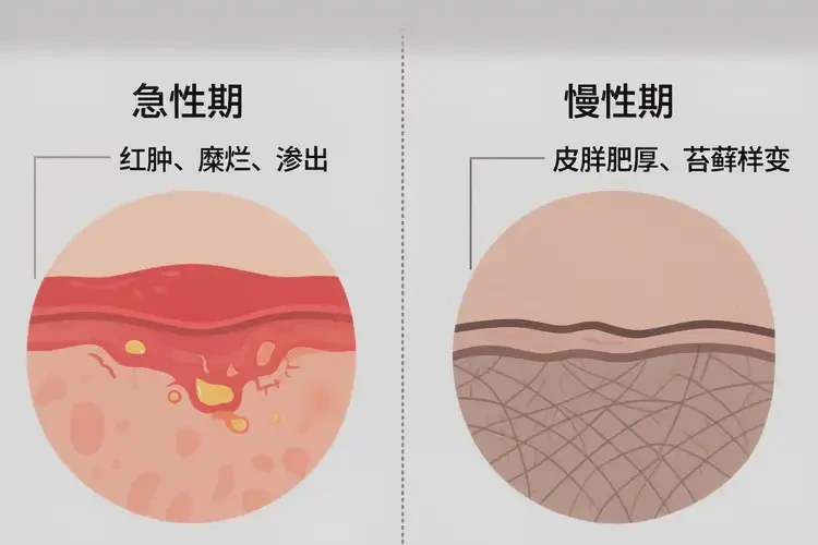 男人肛周出现湿疹可以治好吗(图3)