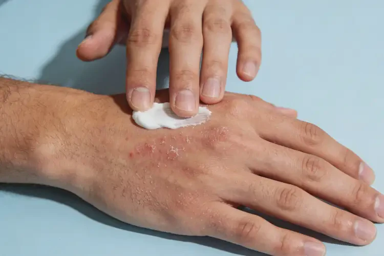 男人手上长湿疹可以治好吗(图3)