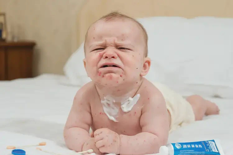 婴儿脖子出现湿疹能治好吗(图3)