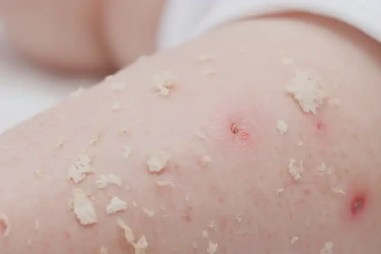 宝宝四肢有湿疹能治好吗(图4)