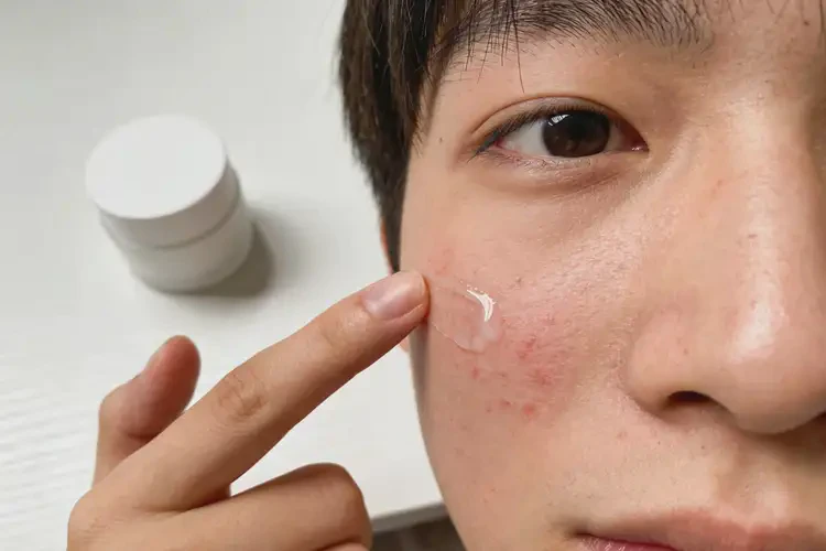 大学生面部出湿疹可不可以彻底自愈(图4)