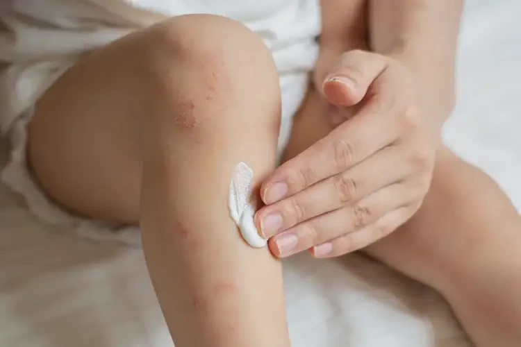 幼儿小腿上经常起湿疹能不能彻底自愈(图2)