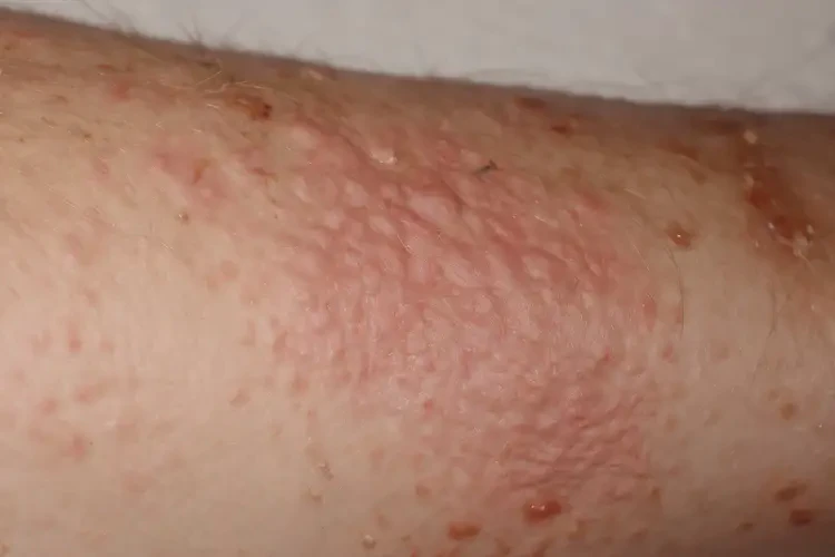 男性身上容易长湿疹不管它会自己痊愈吗(图3)