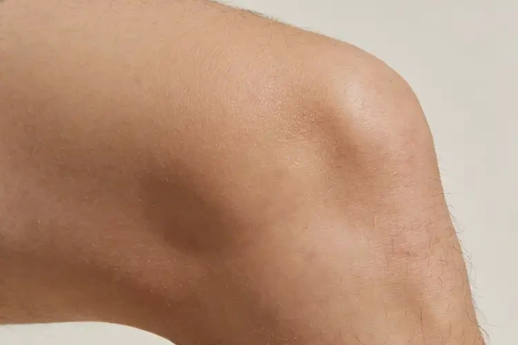 男人大腿上容易起湿疹可以治好吗(图2)