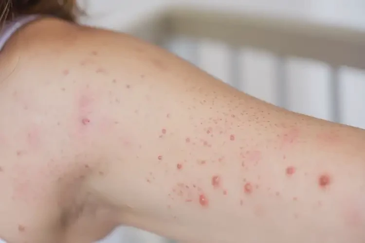 哺乳期妈妈手臂上容易长湿疹可以治好吗(图4)