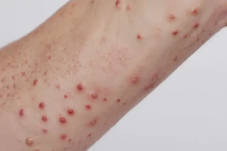 女人身上长湿疹可以治好吗(图4)