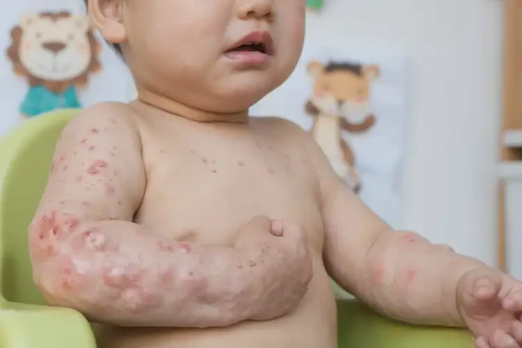 小儿手上偶尔长湿疹可以治好吗(图4)