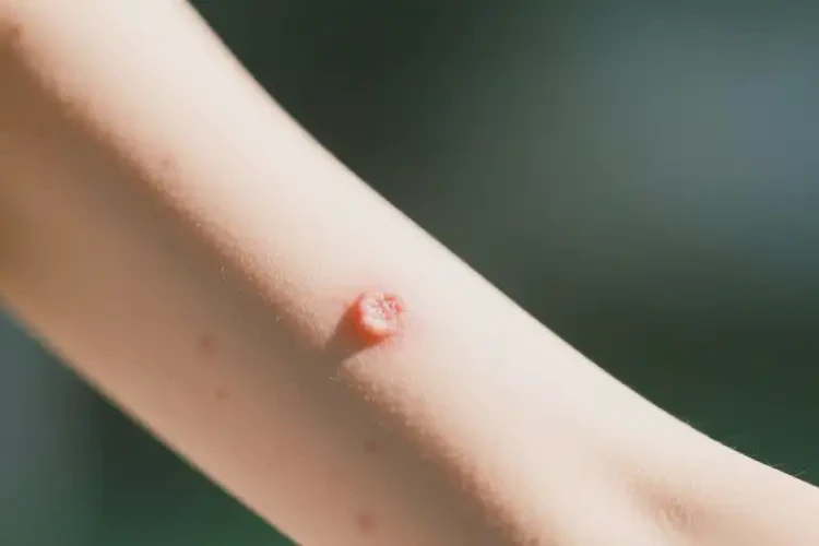 女人手臂上偶尔起湿疹可以治好吗(图4)