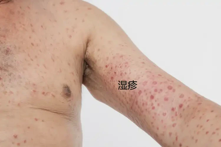 男人身上容易长湿疹可以治好吗(图4)