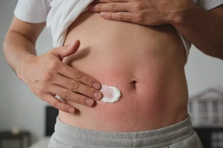 男人肚子上偶尔起湿疹可以治好吗(图3)