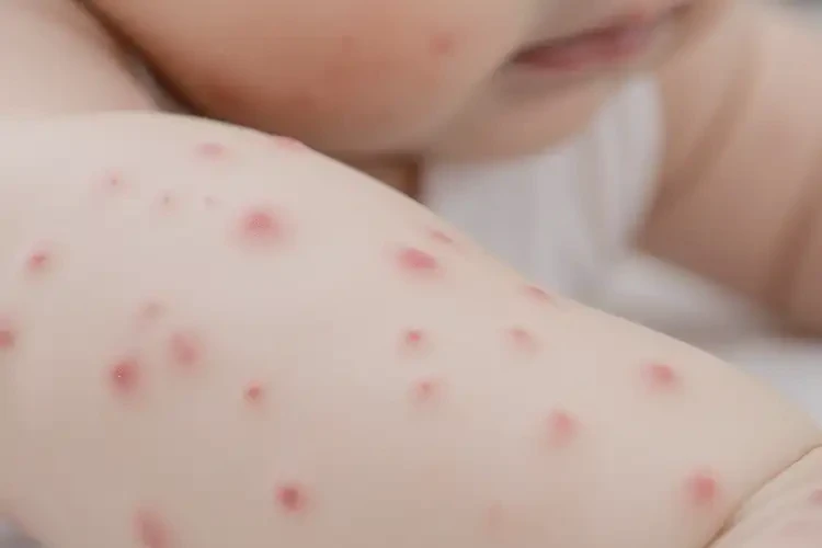 婴幼儿屁股上容易起湿疹能治好吗(图4)