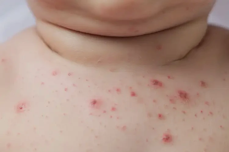 婴儿脖子出湿疹能治好吗(图4)