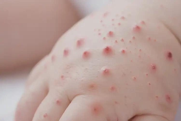 婴幼儿手上容易起湿疹能治好吗(图4)