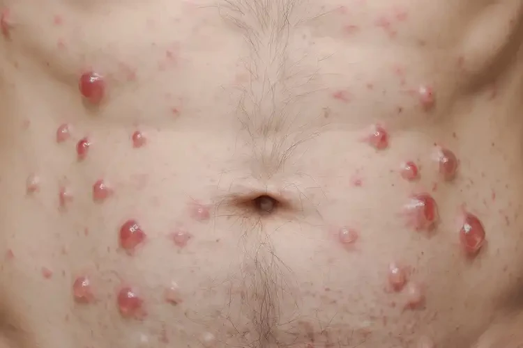 男人肚子上有湿疹可以治好吗(图4)