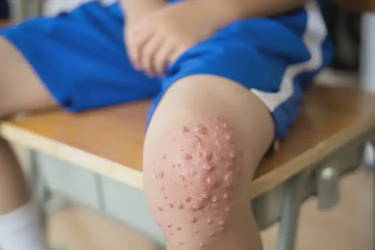 小学生屁股出现湿疹可以治好吗(图3)