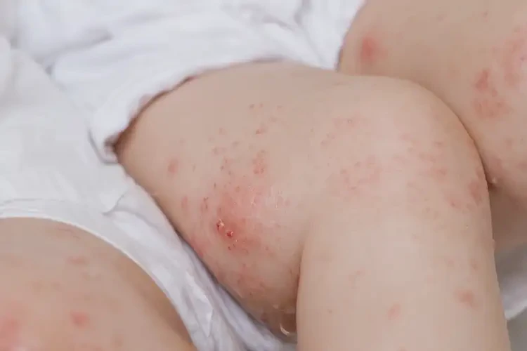 宝宝大腿有湿疹能治好吗(图4)