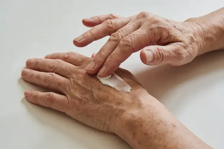 老年人手上出现湿疹不管它会自己痊愈吗(图3)