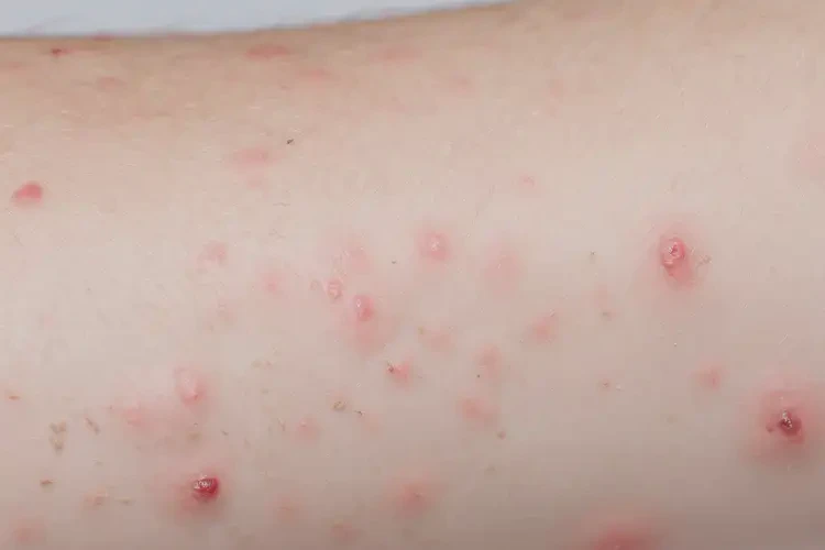 女人手臂上出现湿疹可以治好吗(图4)