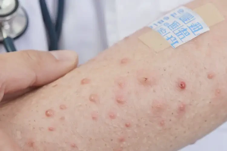 女人身上容易长湿疹可以治好吗(图4)