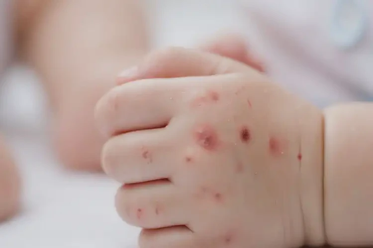 婴幼儿手上偶尔长湿疹能治好吗(图4)