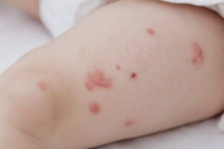 宝宝大腿上偶尔长湿疹能治好吗(图4)