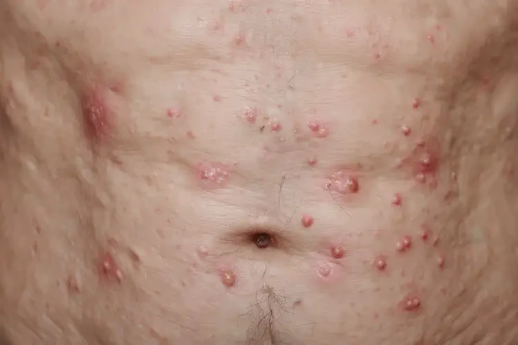 老人肚子上经常起湿疹能靠自己自愈吗(图4)