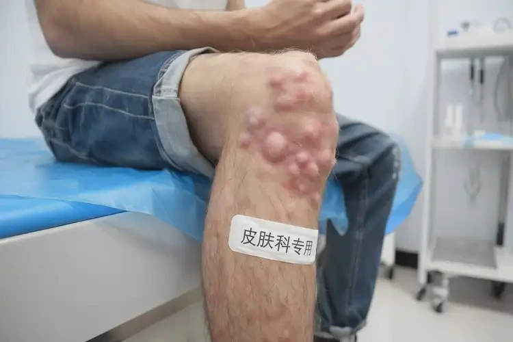 青年人大腿有湿疹可以治好吗(图4)